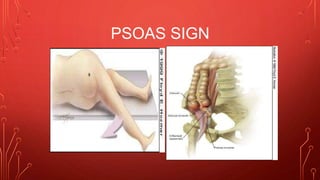 PSOAS SIGN
 