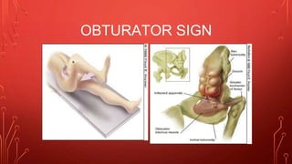 OBTURATOR SIGN
 