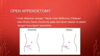 OPEN APPENDETOMY
• Insisi dilakukan dengan Teknik insisi McBurney (Oblique)
atau Rocky Davis (Horizontl) pada sisi kanan bawah di pasien
dengan kecurigaan apendisitis.
 