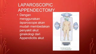 LAPAROSCOPIC
APPENDECTOMY
• Dengan
menggunakan
laparoscope akan
mudah membedakan
penyakit akut
ginekologi dari
Appendicitis akut
 