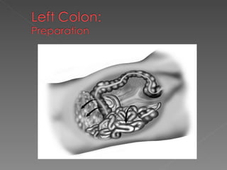 Laparoscopic Resection for Rectal Cancer | PPT
