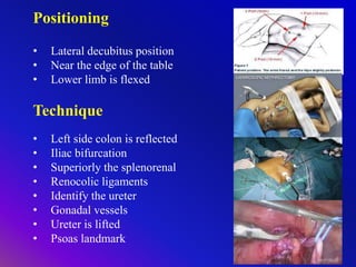 Positioning
• Lateral decubitus position
• Near the edge of the table
• Lower limb is flexed
Technique
• Left side colon is reflected
• Iliac bifurcation
• Superiorly the splenorenal
• Renocolic ligaments
• Identify the ureter
• Gonadal vessels
• Ureter is lifted
• Psoas landmark
 