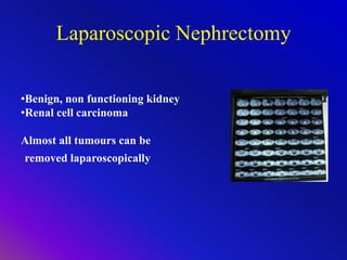 Laparoscopic Nephrectomy
•Benign, non functioning kidney
•Renal cell carcinoma
Almost all tumours can be
removed laparoscopically
 