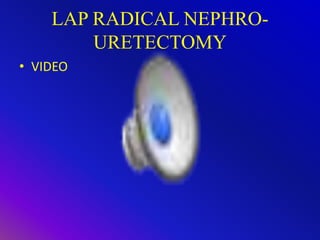 LAP RADICAL NEPHRO-
URETECTOMY
• VIDEO
 