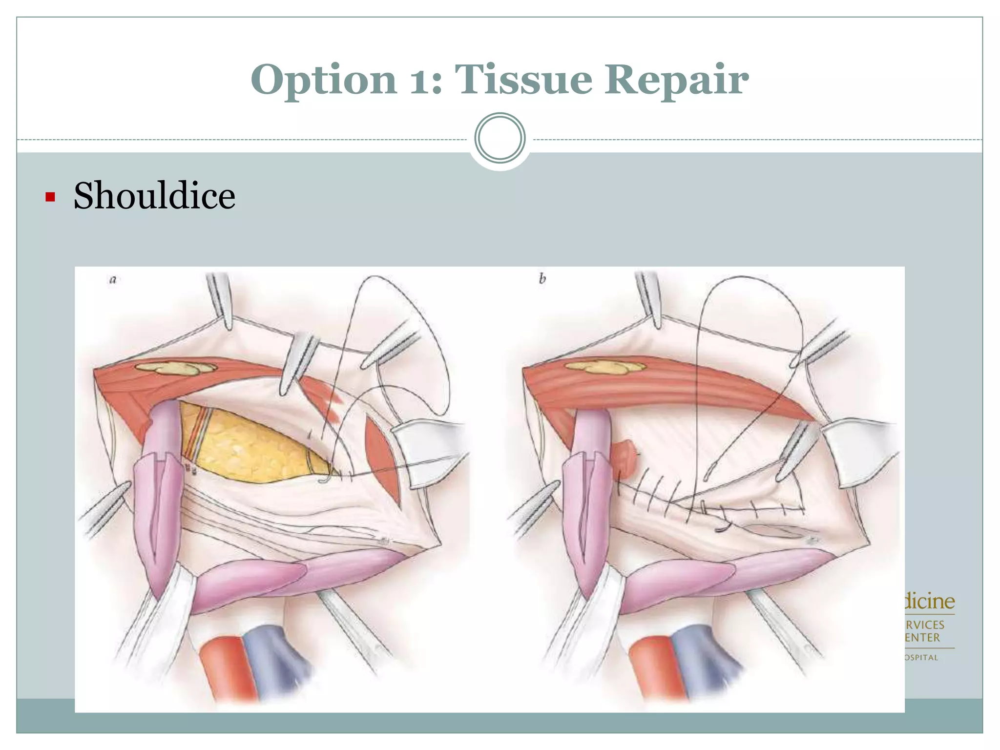Option 1: Tissue Repair
 Shouldice
 