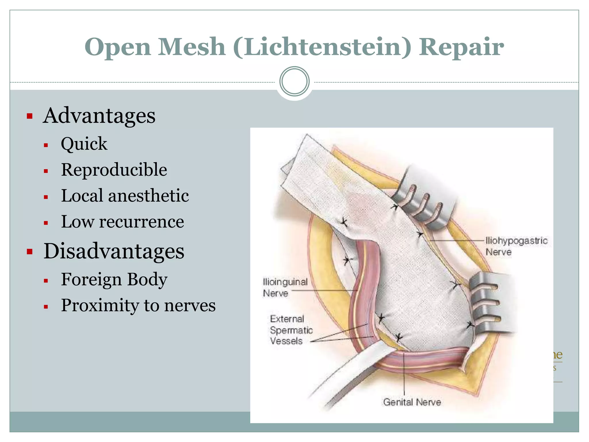 Open Mesh (Lichtenstein) Repair
 Advantages
 Quick
 Reproducible
 Local anesthetic
 Low recurrence
 Disadvantages
 Foreign Body
 Proximity to nerves
 