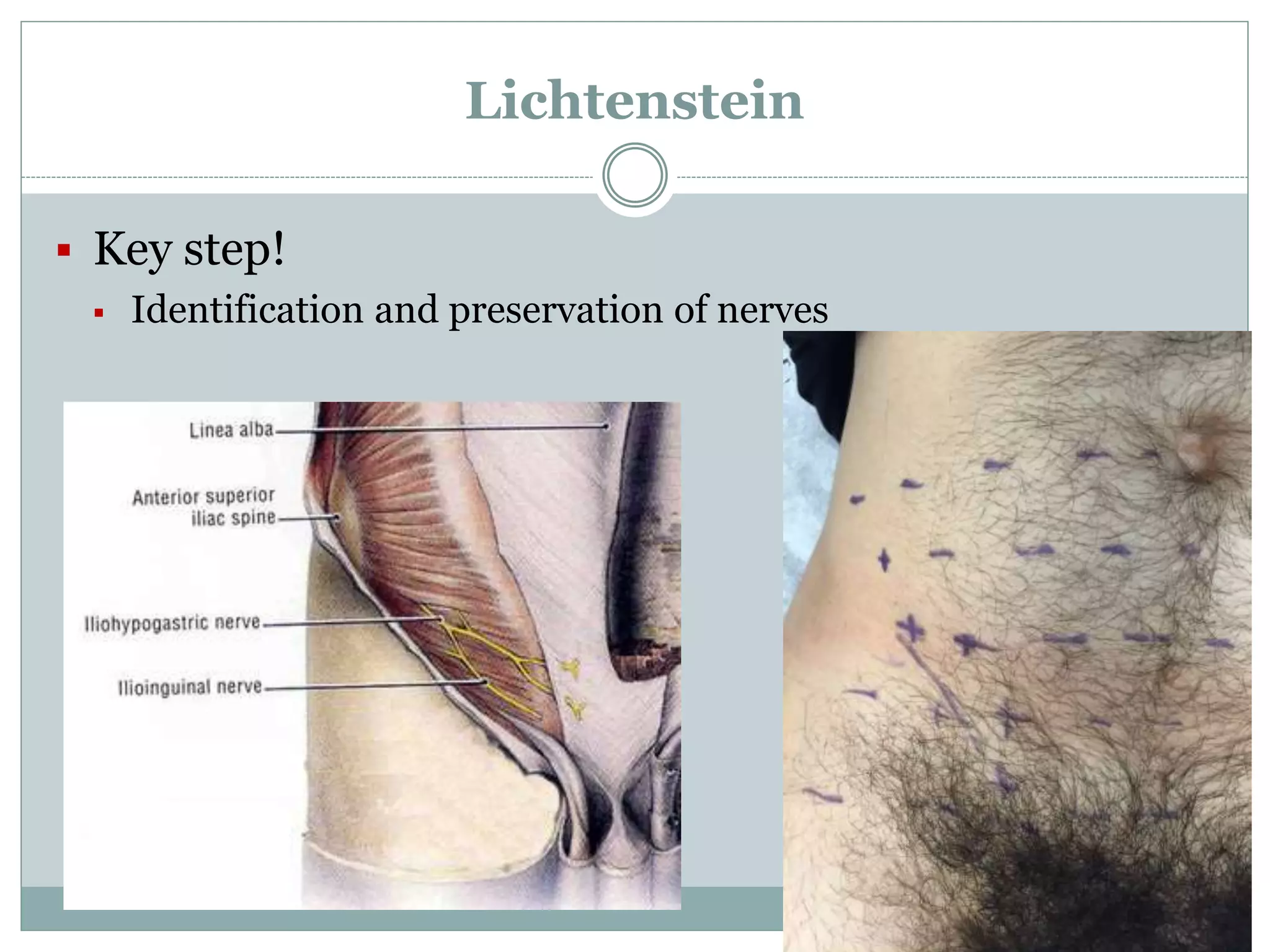Lichtenstein
 Key step!
 Identification and preservation of nerves
 