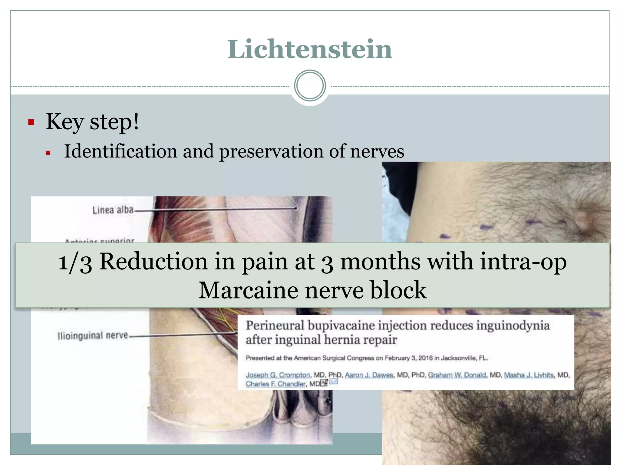 Lichtenstein
 Key step!
 Identification and preservation of nerves
1/3 Reduction in pain at 3 months with intra-op
Marcaine nerve block
 