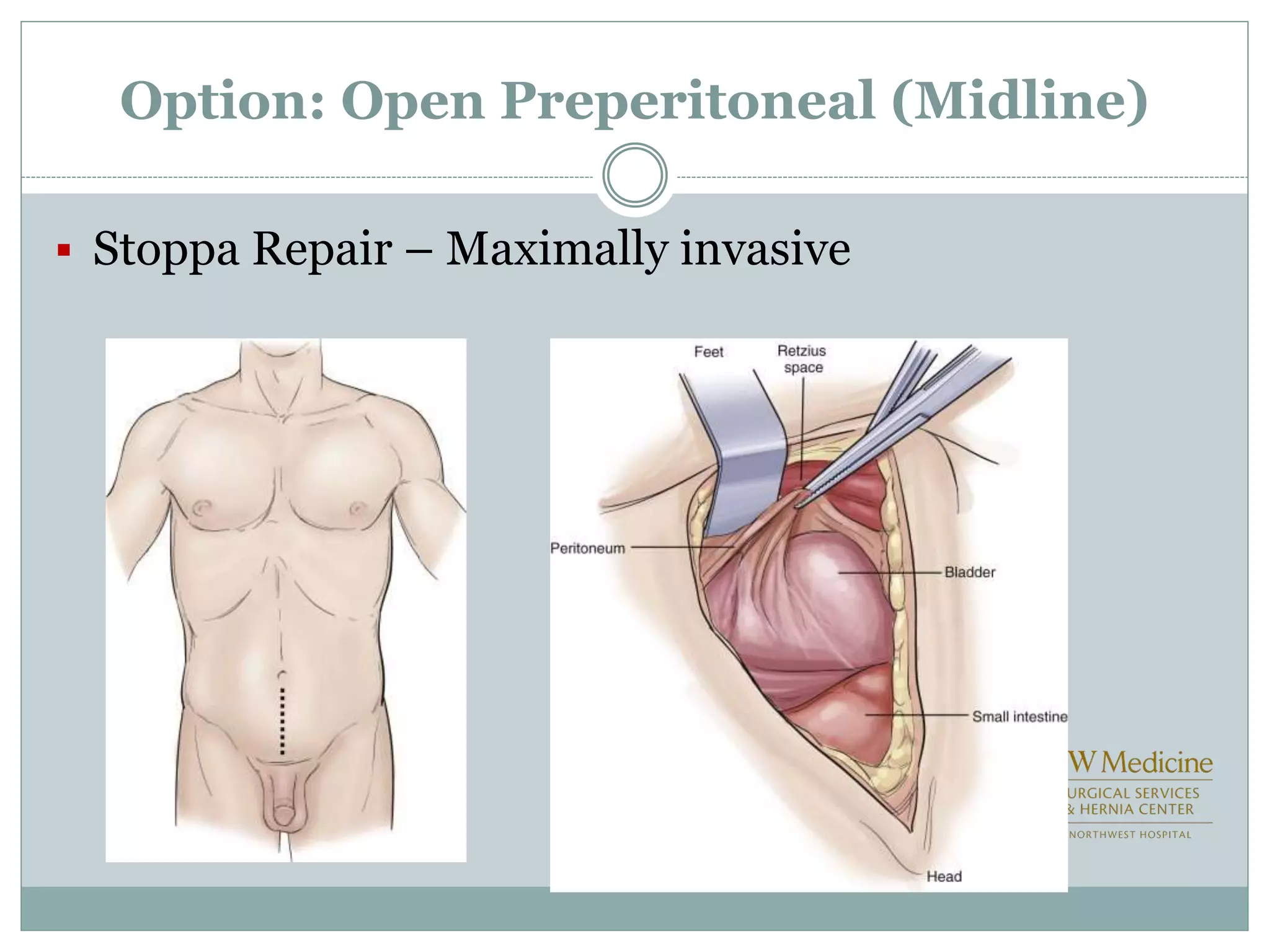 Option: Open Preperitoneal (Midline)
 Stoppa Repair – Maximally invasive
 