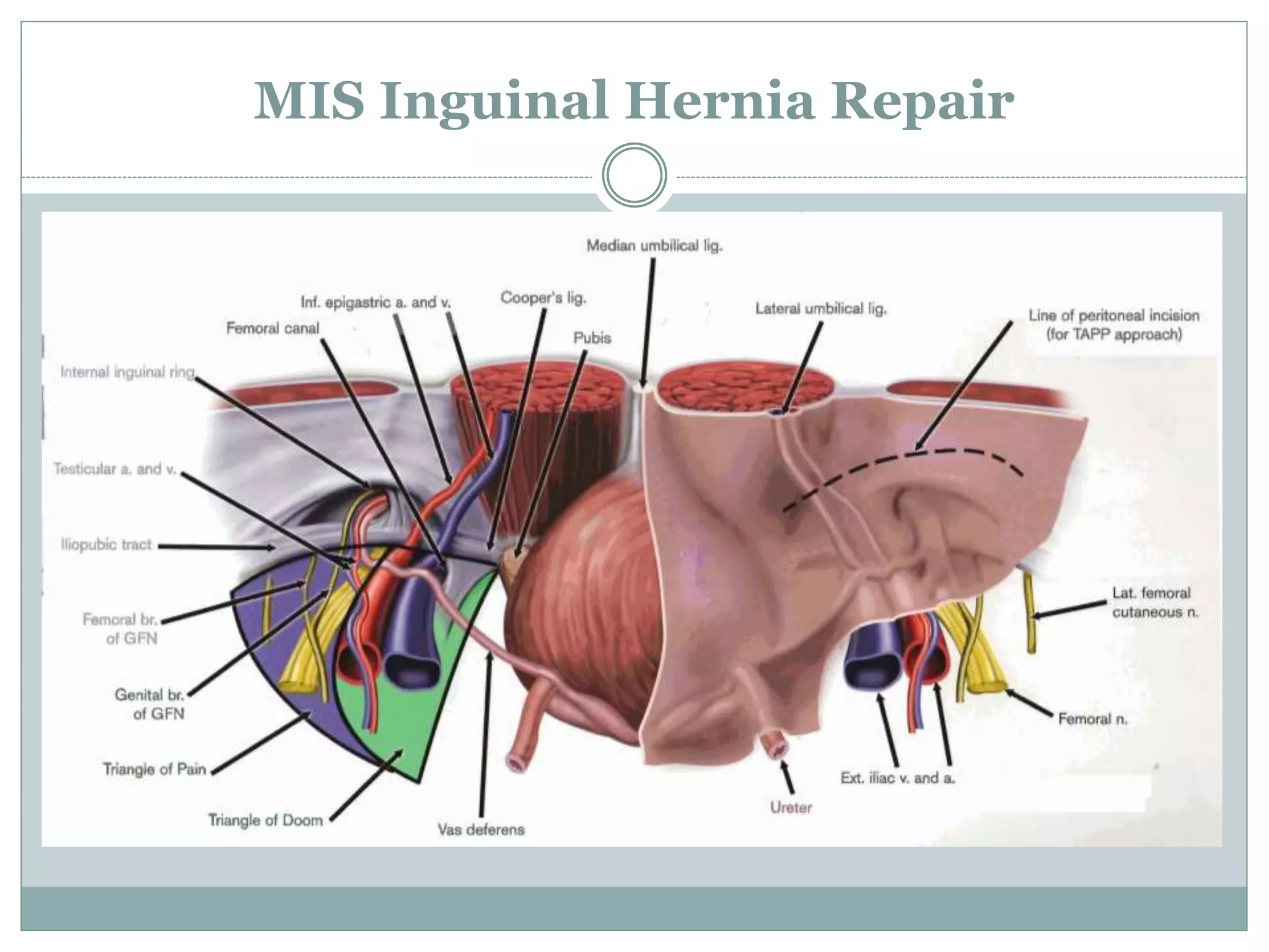 MIS Inguinal Hernia Repair
 