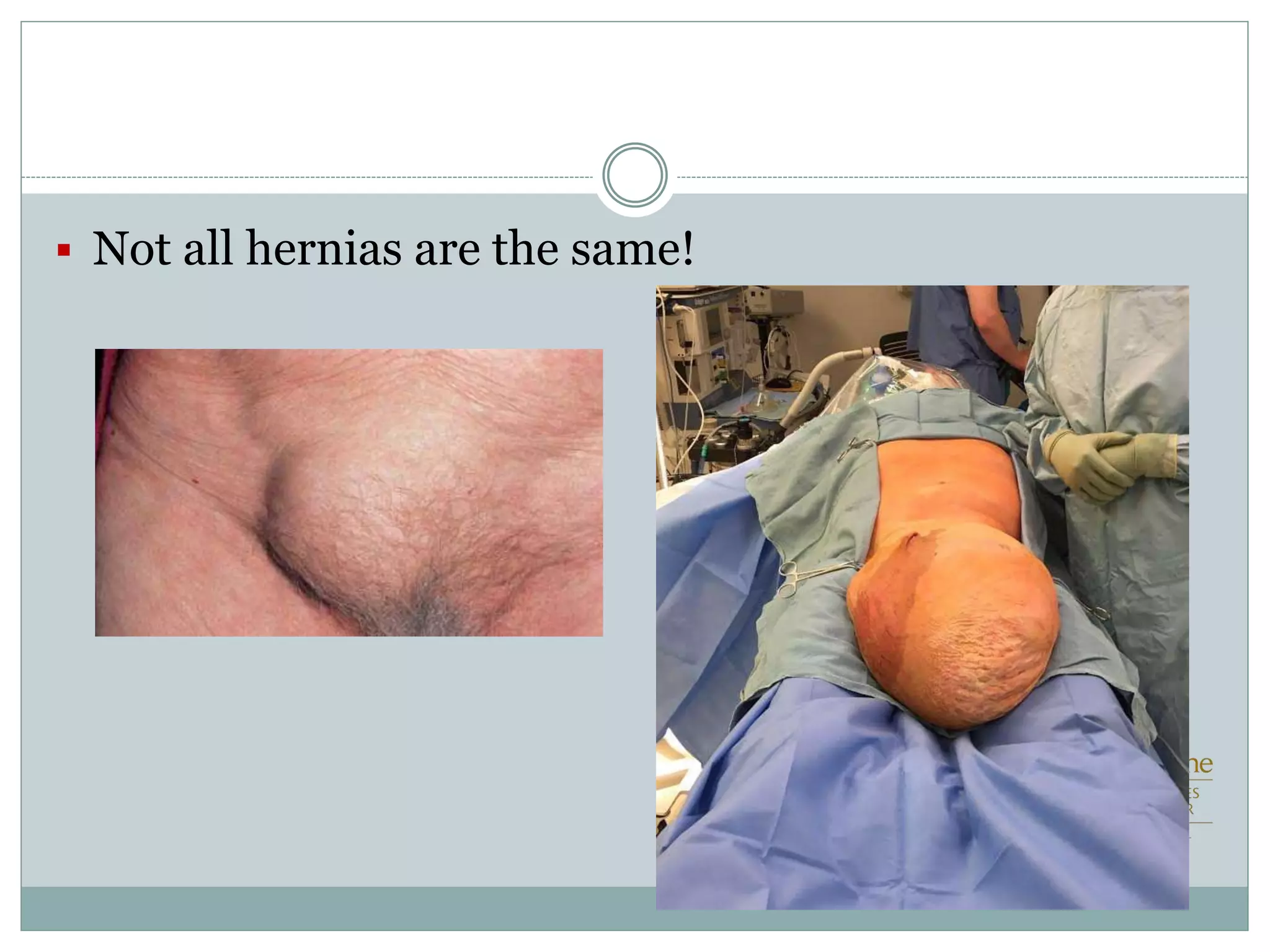  Not all hernias are the same!
 