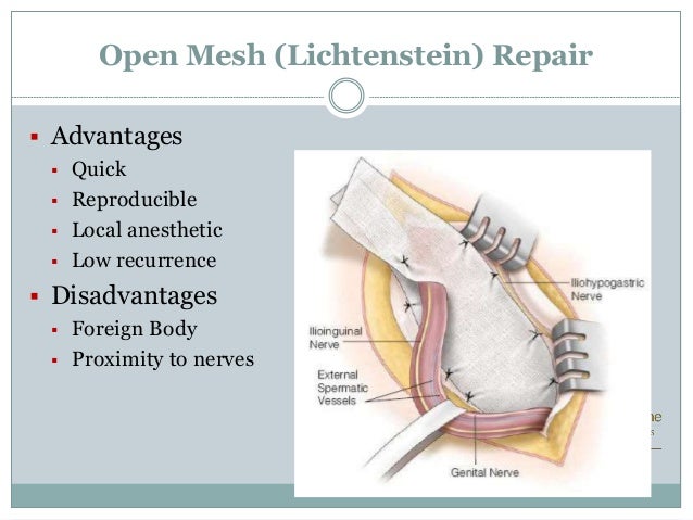 What happens during laparoscopic hernia repair?
