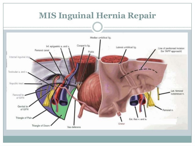 Laparoscopic Vs Open Inguinal Hernia Repair