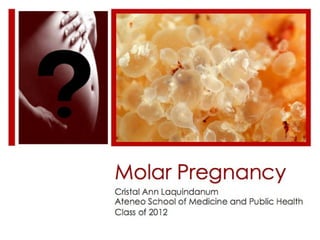 Molar Pregnancy Cristal Ann Laquindanum Ateneo School of Medicine and Public Health Class of 2012 