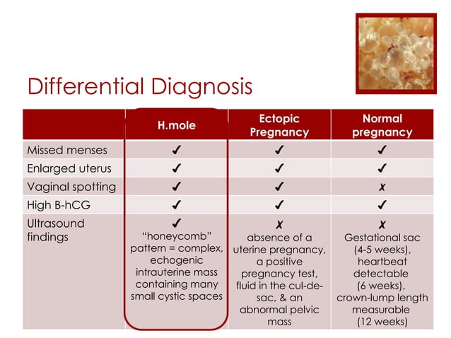 Molar Pregnancy