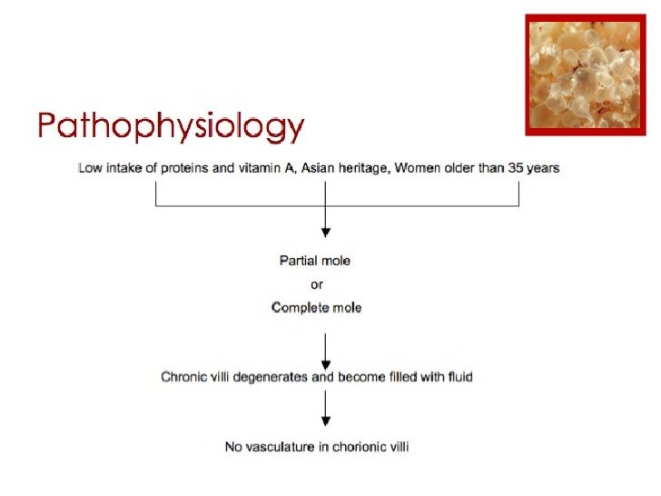 Molar Pregnancy Molar Pregnancy