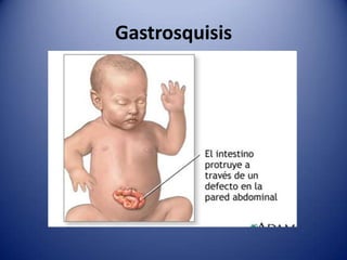 Gastrosquisis
 