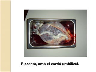 Placenta, amb el cordó umbilical.
 