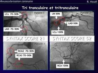 Syntax Score Lad La revascularisation chirurgicale | PPTX
