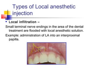 Types of Local anesthetic 
injection 
 Local infiltration – 
Small terminal nerve endings in the area of the dental 
treatment are flooded with local anesthetic solution. 
Example: administration of LA into an interproximal 
papilla. 
 