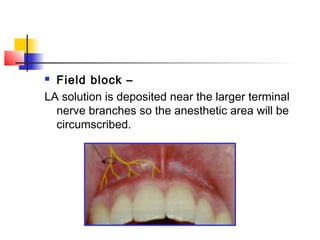  Field block – 
LA solution is deposited near the larger terminal 
nerve branches so the anesthetic area will be 
circumscribed. 
 