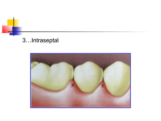 3…Intraseptal 
 