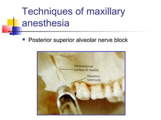 Techniques of maxillary 
anesthesia 
 Posterior superior alveolar nerve block 
 