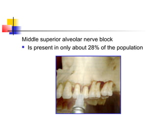 Middle superior alveolar nerve block 
 Is present in only about 28% of the population 
 