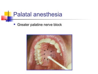 Palatal anesthesia 
 Greater palatine nerve block 
 