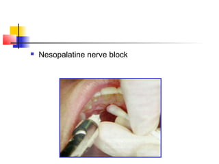  Nesopalatine nerve block 
 