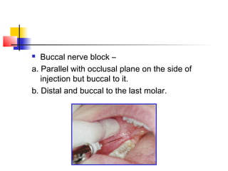  Buccal nerve block – 
a. Parallel with occlusal plane on the side of 
injection but buccal to it. 
b. Distal and buccal to the last molar. 
 