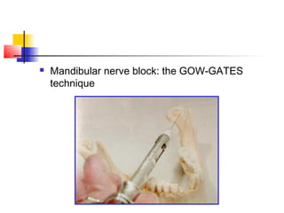  Mandibular nerve block: the GOW-GATES 
technique 
 