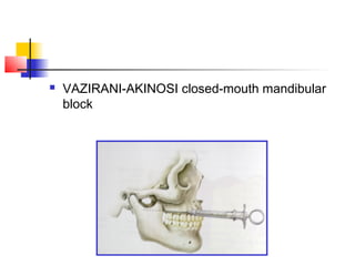  VAZIRANI-AKINOSI closed-mouth mandibular 
block 
 