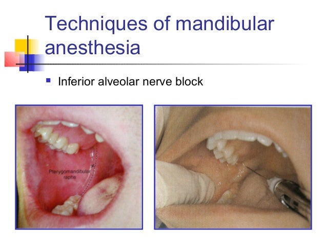 inferior alveolar nerve block