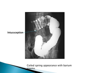 Large bowel obstruction | PPTX