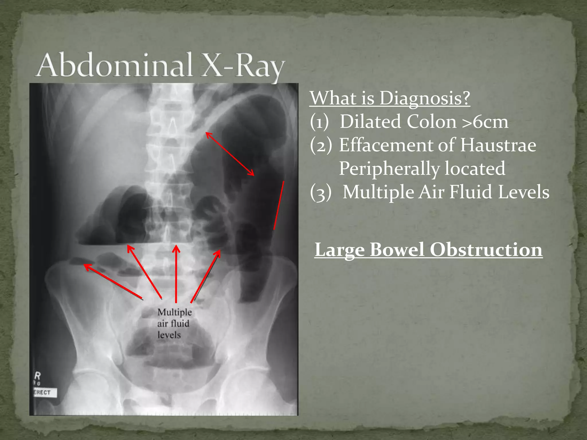 What is Diagnosis?
(1) Dilated Colon >6cm
(2) Effacement of Haustrae
    Peripherally located
(3) Multiple Air Fluid Levels

Large Bowel Obstruction
 