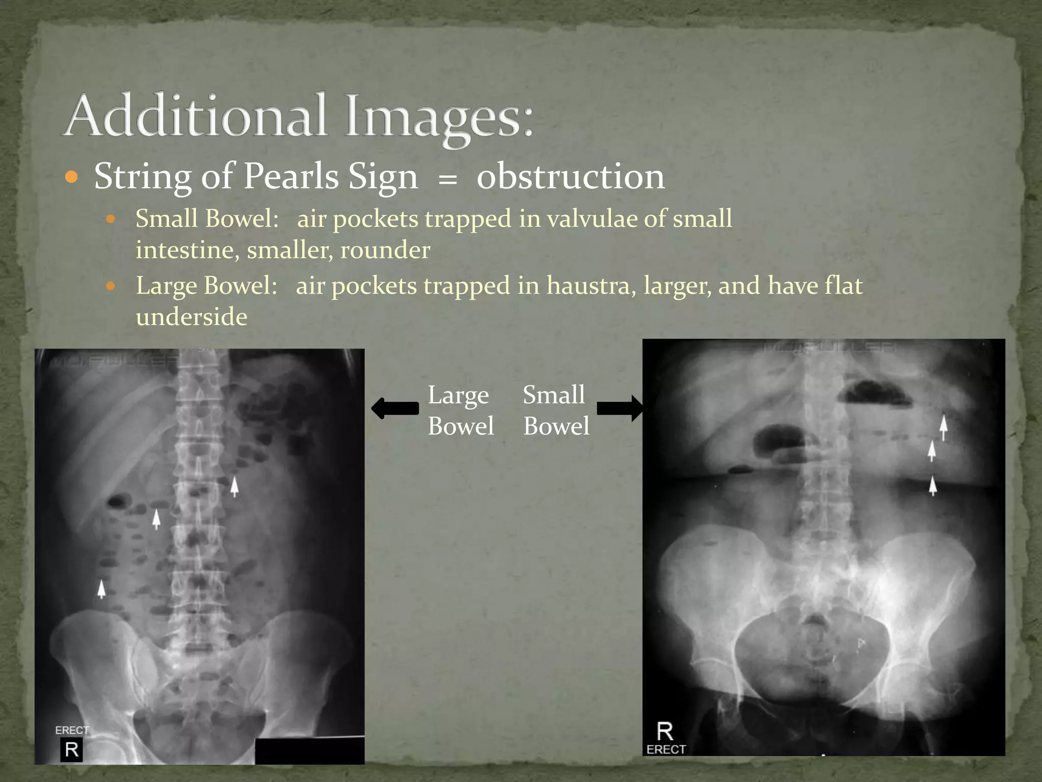  String of Pearls Sign = obstruction
   Small Bowel: air pockets trapped in valvulae of small
    intestine, smaller, rounder
   Large Bowel: air pockets trapped in haustra, larger, and have flat
    underside


                              Large    Small
                              Bowel    Bowel
 