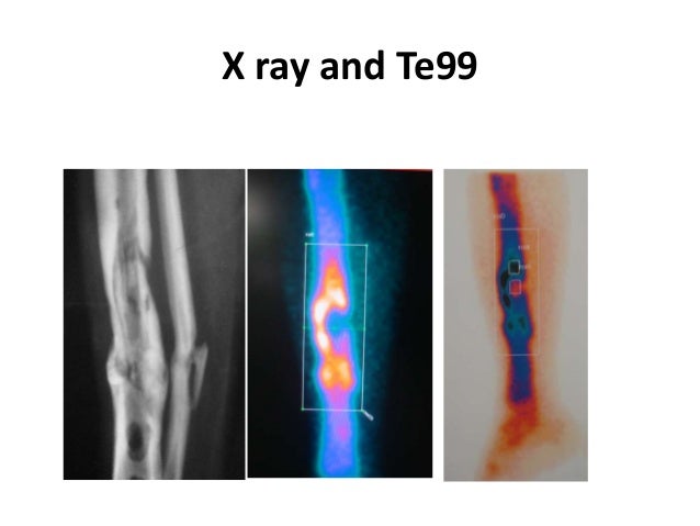 compression distraction osteosynthesis On dec 1, 1971 ga ilizarov published: basic principles of transosseous compression and distraction osteosynthesis. compression distraction osteosynthesis On dec 1, 1971 ga ilizarov published: basic principles of transosseous compression and distraction osteosynthesis.