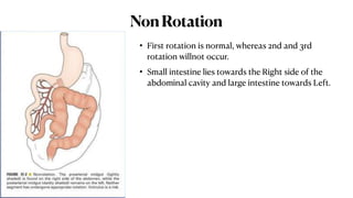Reverse Rotation Intestine Comprehensive Overview of Large Intestine Anatomy and Malrotation ...