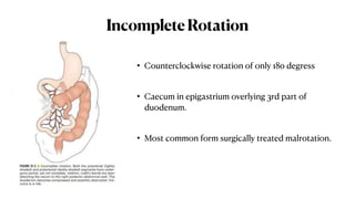 Reverse Rotation Intestine Comprehensive Overview of Large Intestine Anatomy and Malrotation ...