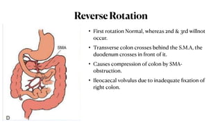 Reverse Rotation Intestine Comprehensive Overview of Large Intestine Anatomy and Malrotation ...