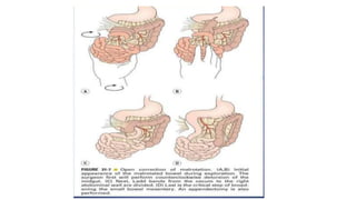 Stool Internal Rotation Comprehensive Overview of Large Intestine Anatomy and Malrotation ...