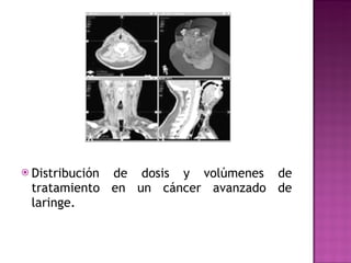 Distribución de dosis y volúmenes de tratamiento en un cáncer avanzado de laringe. 