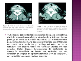 TC helicoidal del cuello: lesión ocupante de espacio infiltrativa a nivel de la pared posterolateral derecha de la tráquea, la cual protruye en forma de mamelón hacia la luz con infiltración de su pared extendiéndose hasta los senos piriformes, con infiltración de cuerda vocal verdadera y cartílago cricoides casi en su totalidad, con erosión medial del cartílago tiroideo del lado derecho. Dichas lesiones heterogéneas de coeficiente de atenuación semisólido, de bordes mal definidos, con una extensión en longitud de aproximadamente 2 cm de largo por 2 cm en sentido transverso y antero posterior  
