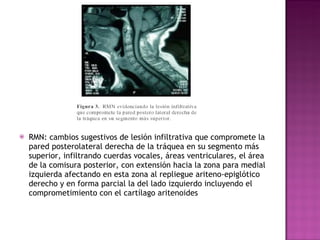 RMN: cambios sugestivos de lesión infiltrativa que compromete la pared posterolateral derecha de la tráquea en su segmento más superior, infiltrando cuerdas vocales, áreas ventriculares, el área de la comisura posterior, con extensión hacia la zona para medial izquierda afectando en esta zona al repliegue ariteno-epiglótico derecho y en forma parcial la del lado izquierdo incluyendo el comprometimiento con el cartílago aritenoides  