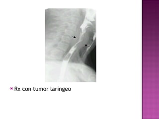 Rx con tumor laringeo 