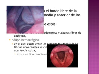 La mayoría ocurren en el borde libre de la unión entre el tercio medio y anterior de los pliegues vocales. Existen dos subtipos de estos:  pólipo gelatinoso: compuesto de estroma edematoso y algunas fibras de colágeno,  pólipo hemorrágico  en el cual existe entre los organizados depósitos de fibrina unos canales vascularizados que le dan su apariencia rojiza;  existe un tipo combinado, el más frecuentemente 