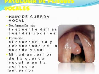 PATOLOGÍA DE PLIEGUES
VOCALES
 PÓLIPO D E C U E R D A
  V OCA L
 Neoformación más
  f r e c u e n t e d e l a s
  c u e r d a s v o c a l e s
 Formación
  c i r c u n s c r i t a y
  r e d o n d e a d a d e l a
  c u e r d a v o c a l
 Mi t a d a n t e r i o r
  d e l a c u e r d a
  v o c a l o e n l a
  c o mi s u r a
  a n t e r i o r
 