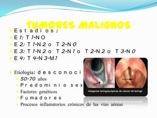    E
          TUMORES MALIGNOS
        s t a d i o s :
   E   1: T 1-N O
   E   2: T 1-N 2 o T 2-N 0
   E   3: T 1-N 2 o T 2-N 1 o T 2-N 2 o T 3-N 0
   E   4: T 4-N 3-M 1

 Etiología: d e s c o n o c i d a
    50-70 años
    P r e d o mi n i o s e x o ma s c u l i n o
    Factores genéticos
    F u ma d o r e s
    Procesos inflamatorios crónicos de las vías aéreas
 