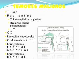 TUMORES MALIGNOS
 T T O:
Ra d i a n t e :
    T 1 supraglóticos y glóticos
    Recidivas locales
     postquirúrgicas
   T 4
 QX
 Resección endoscópica
 Cordectomía s i m p l e
 Laringectomía
  f r o n t a l
  a n t e r i o r
 Laringectomía
  p a r c i a l
 